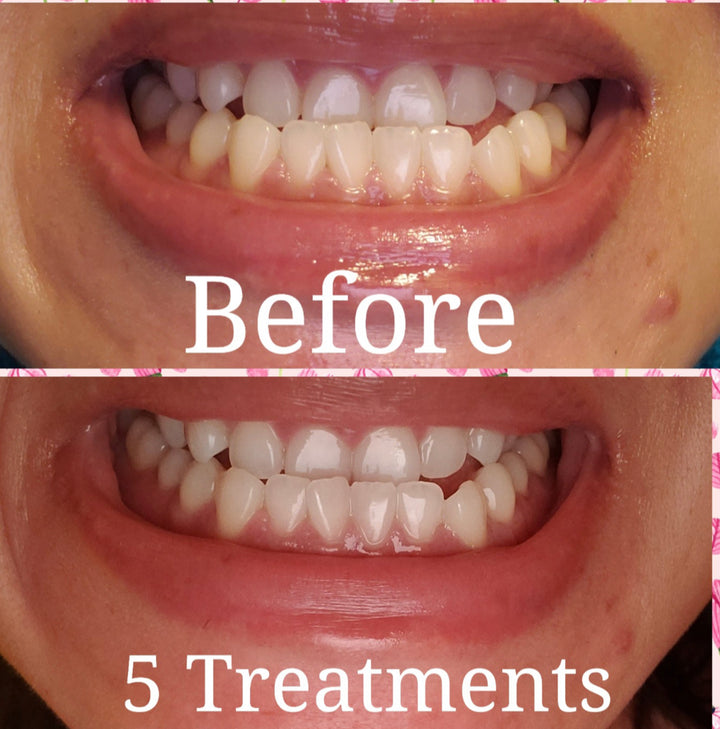 Before and after white teeth