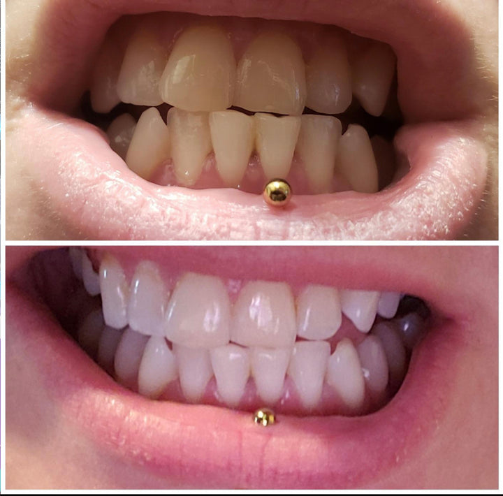 Before and after white teeth