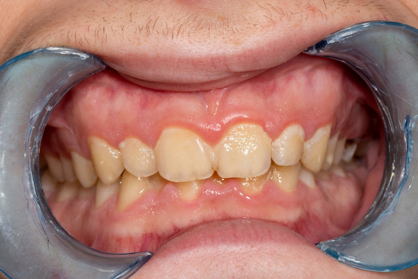 Gingivitis and inflammation of your gums.