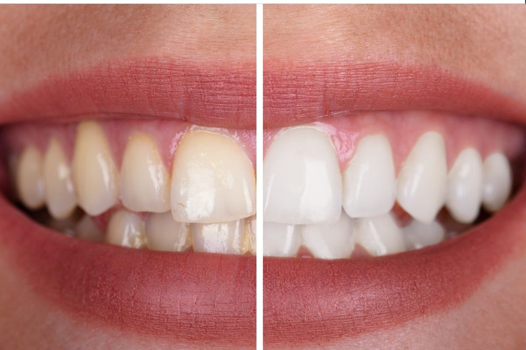 Carbamide Peroxide vs. Hydrogen Peroxide: The Best Teeth Whitening Choice.