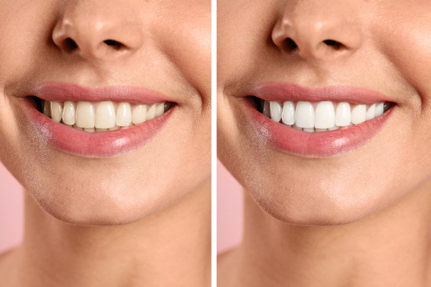 Celebrity White Teeth Whitening before and After. Whiter Teeth Fast.
