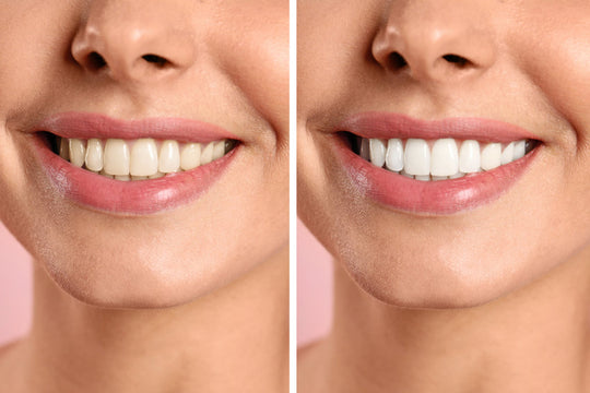 Celebrity White Teeth Whitening before and After. Whiter Teeth Fast.